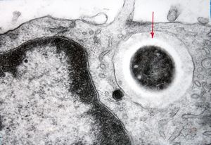 M,43y. | fungi in blood (Candida v.s.) - mycoseption